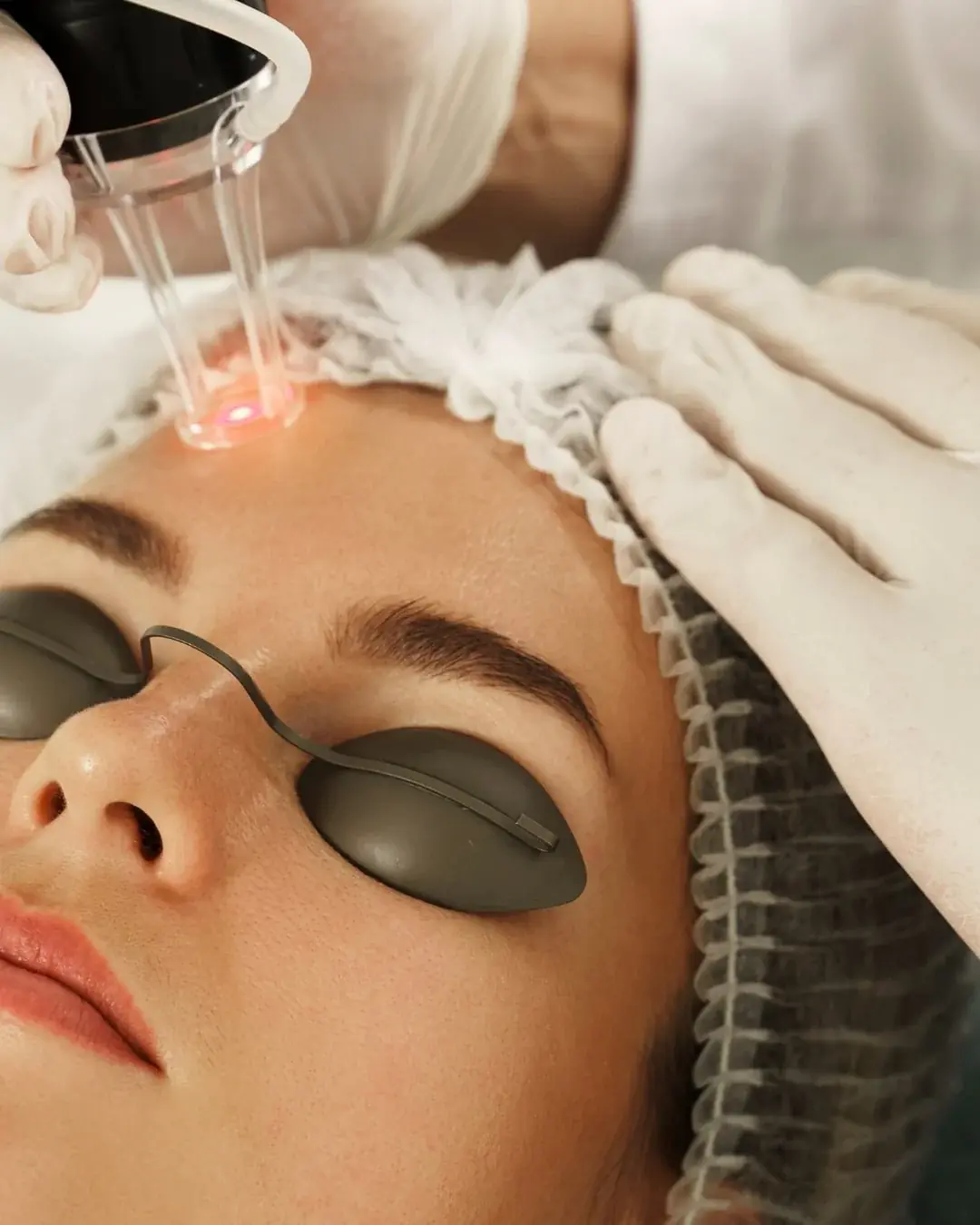 Laser skin resurfacing