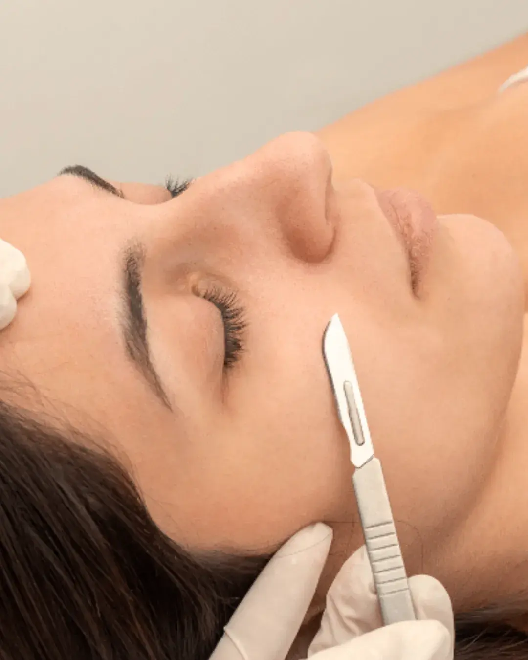 Dermaplaning treatment — gentle exfoliation removing peach fuzz and dead skin cells