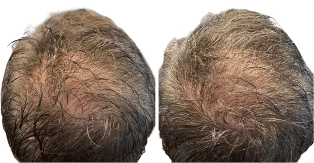 Scalp health and hair rejuvenation before and after results at Dermáge Aesthetics