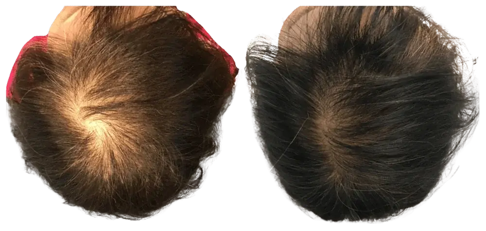 Hair restoration results
