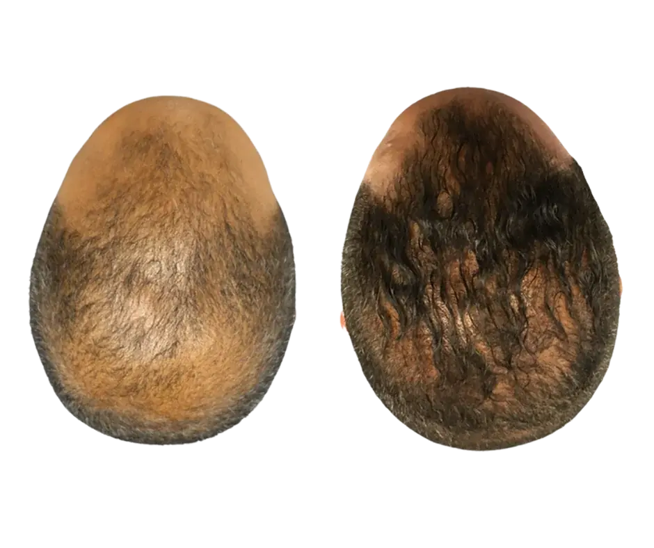 Improved hair density