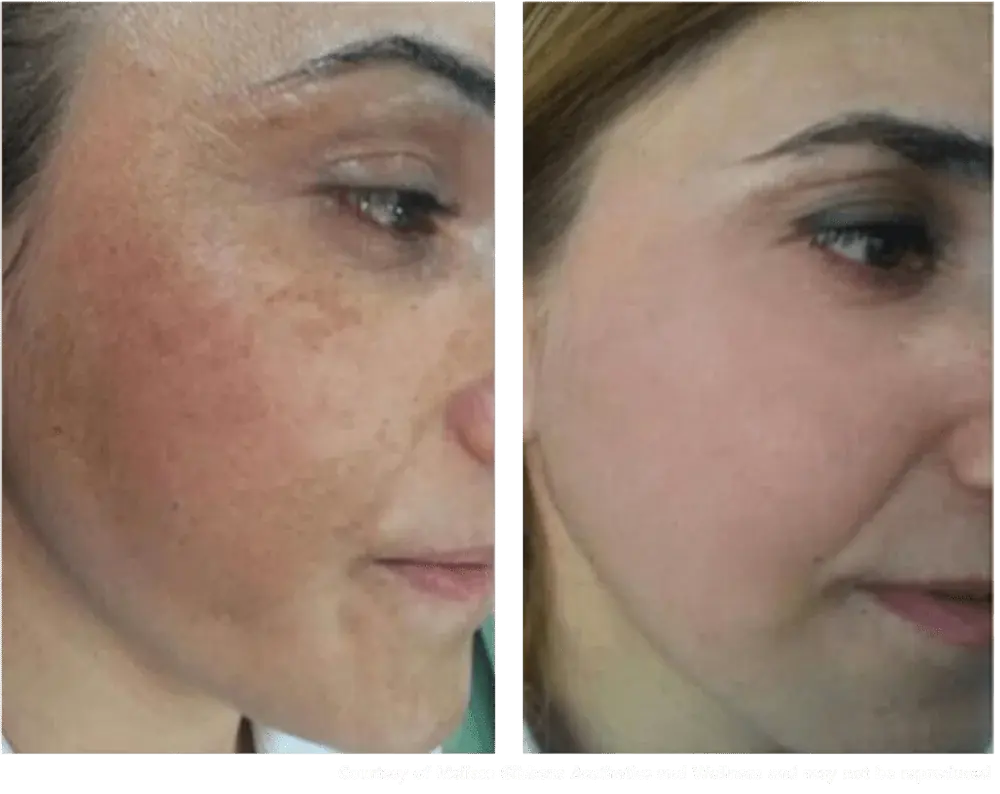 Laser results