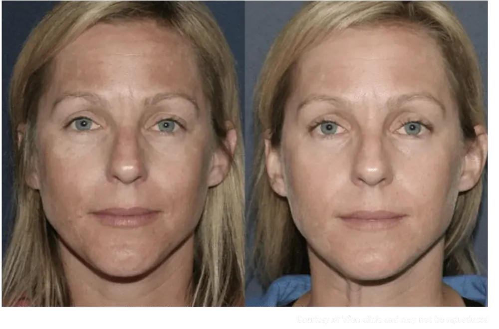 Laser rejuvenation result
