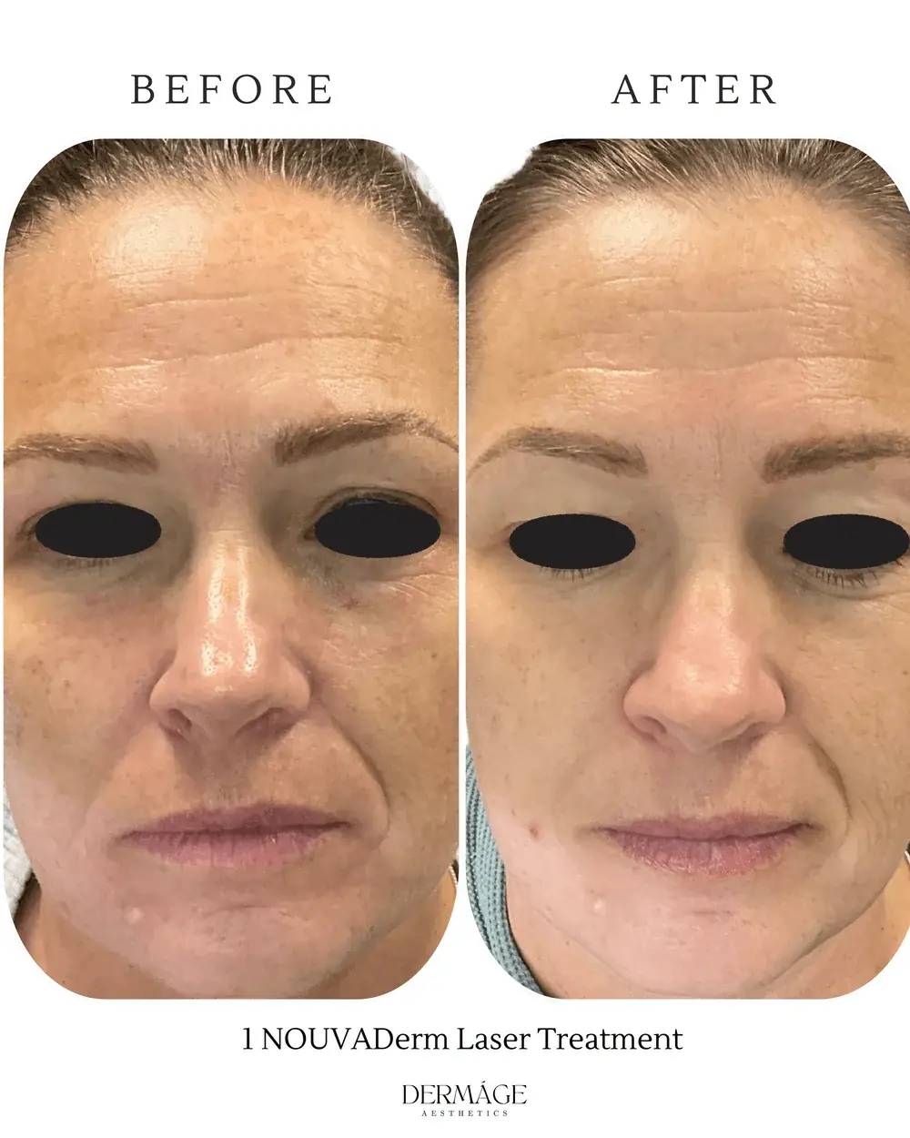 Even skin tone after laser