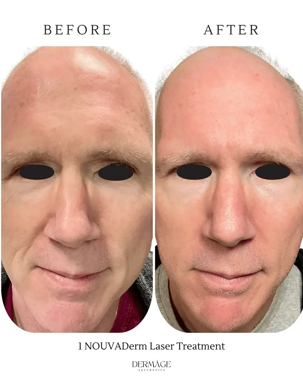Clear skin after laser