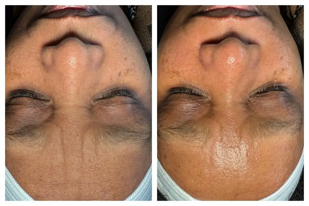 Clear, healthy skin result