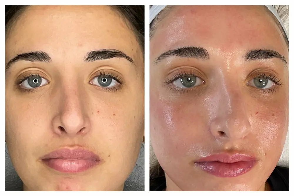 Even-toned skin result
