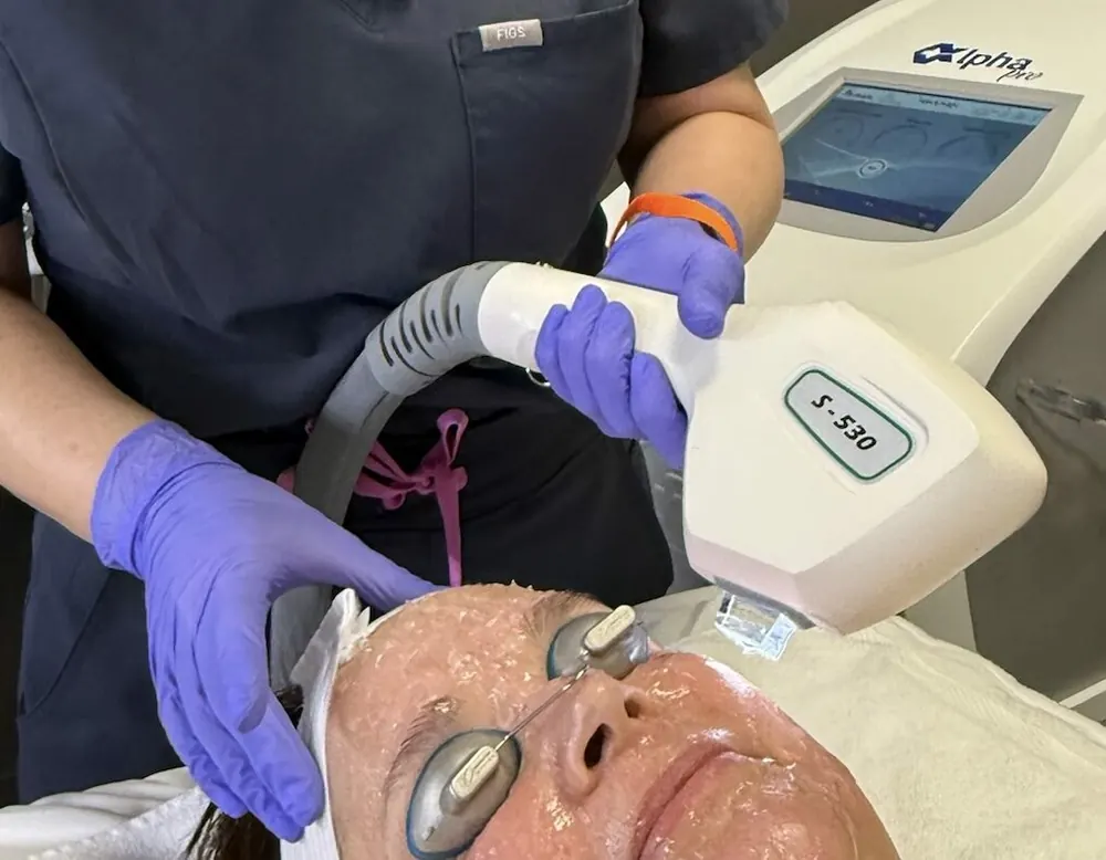 Laser skin resurfacing treatment with the Alpha Pro system in Vancouver, WA