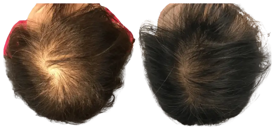 NouvaDerm scalp health and hair restoration before and after results in Vancouver, WA