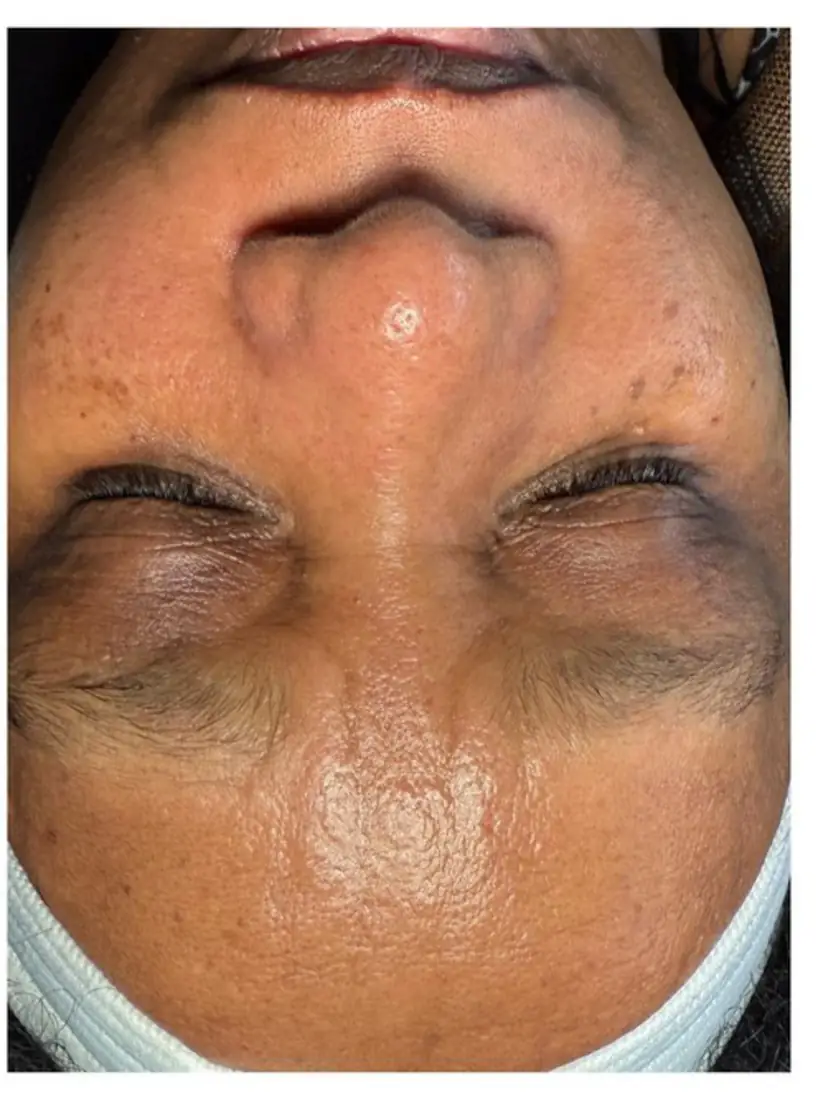 Real client skin after treatment — clearer, smoother, more even and hydrated