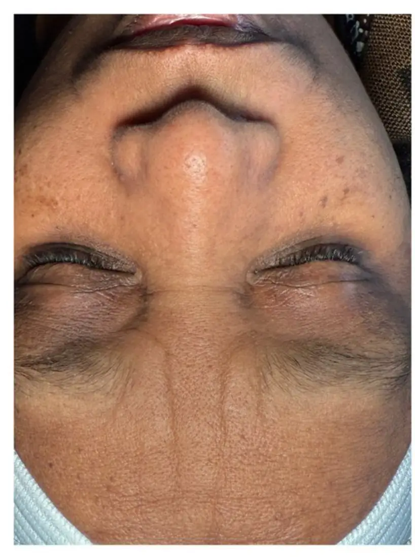 Real client skin before treatment — uneven tone, texture and pigmentation