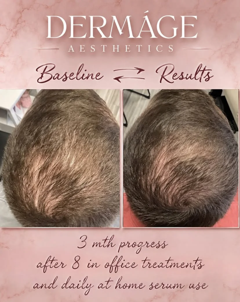 Three-month hair restoration progress at Dermáge Aesthetics