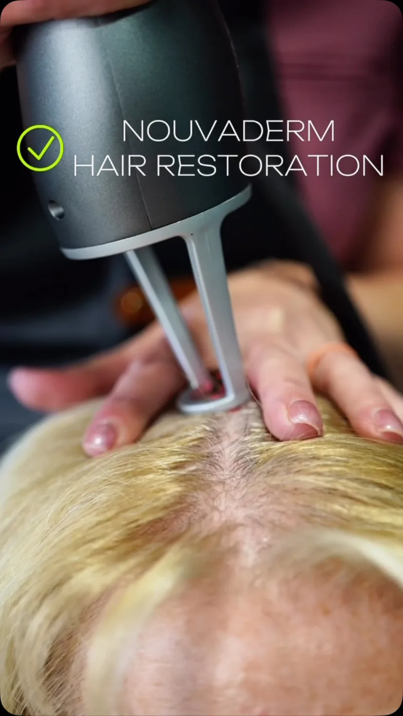 Close-up of a NOUVADerm laser handpiece on a client's scalp during a hair restoration treatment