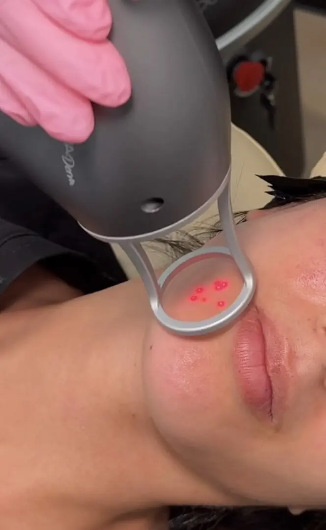 Glow & Go Laser Facial with the NouvaDerm laser