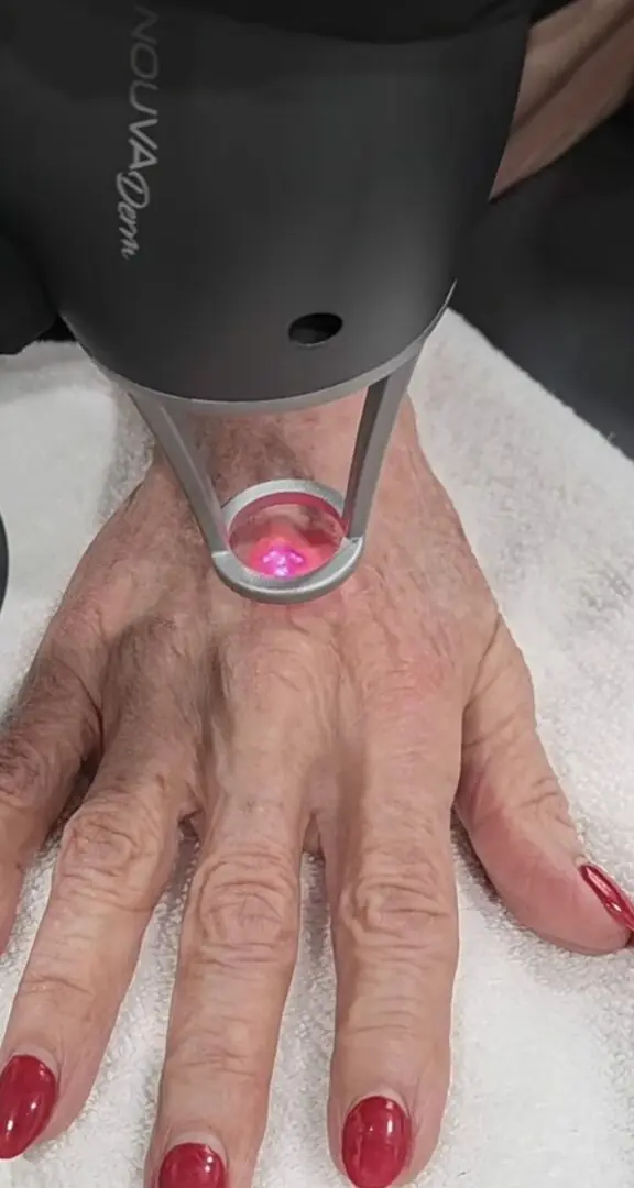Radiance Revived laser treatment for sun damage and pigmentation