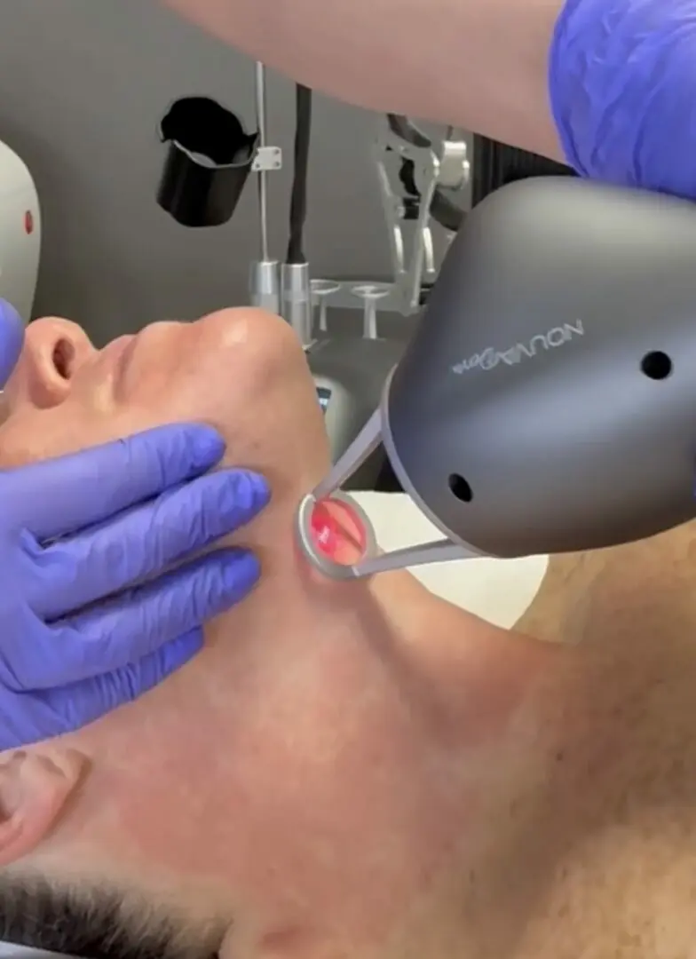 Rejuvenation Renewed full laser resurfacing including the neck