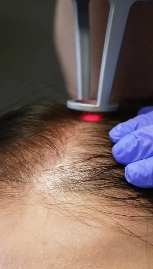 Complete Scalp Renewal combining HydraFacial and NouvaDerm
